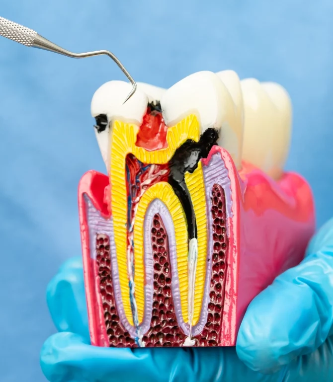 Root Canal<br />
Therapy